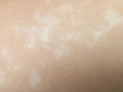 小腿长白斑是什么原因引起的