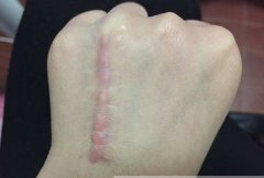 疤痕该怎么治疗