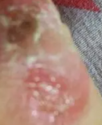 创口面积大怎么去除疤痕