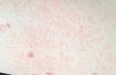 大腿湿疹是怎么引起的