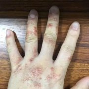 湿疹是怎么引起