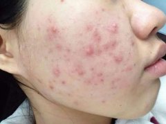面上长痤疮是什么原因