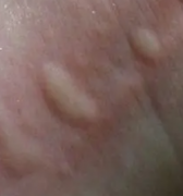 冷性荨麻疹是什么原因引起的
