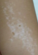 手臂上长白斑点是什么原因造成的