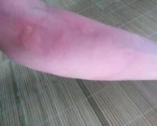出现荨麻疹的原因