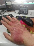 湿疹是什么原因引起的