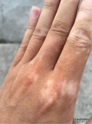 白癜风的原因是什么