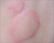皮肤划痕荨麻疹有什么危害