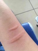 荨麻疹是什么东西引起的