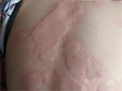 为什么会导致荨麻疹