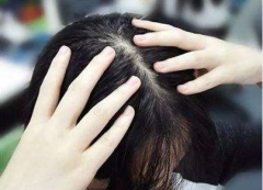 解决脱发的方法有什么