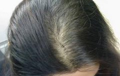脱发如何改善和恢复？