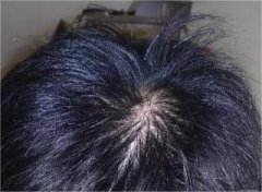 脂溢性脱发怎么治